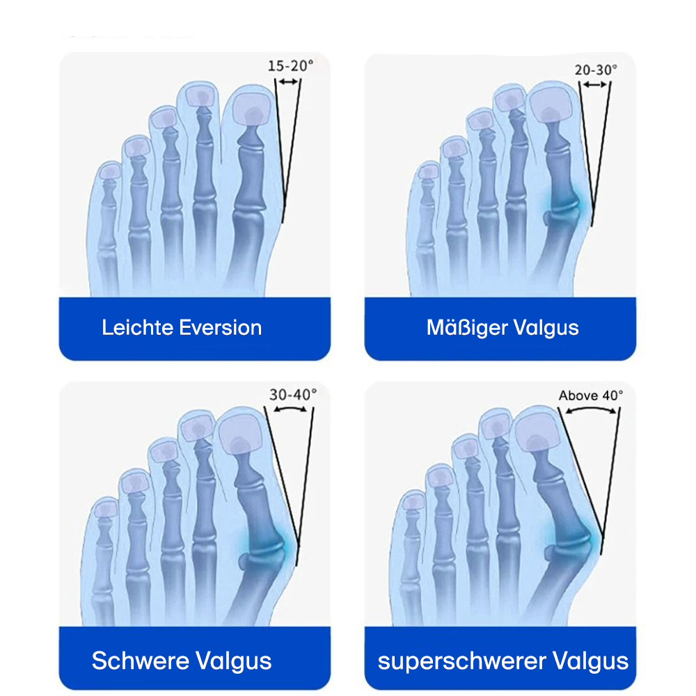 BunionFixer™: Die ideale Lösung zur Linderung von Fußschmerzen – Medizinisches, anpassbares Design für höchsten Komfort (90 Tage risikofreie Testphase)